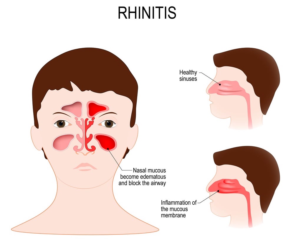 Image comparing healthy versus inflamed sinuses. The inflammation of the mucous membrane and the accumulation of watery fluids block the airways.