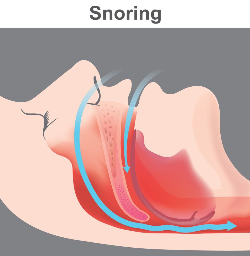 The vibration of partially obstructed respiratory structures during sleep results in snoring