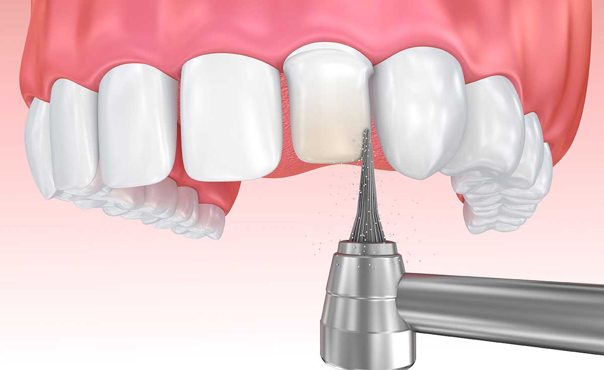 Enamel shaving before placing a porcelain veneer
