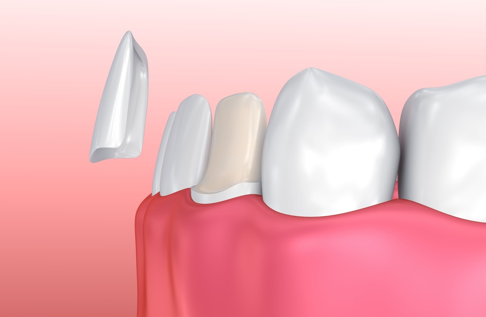 Dental veneer