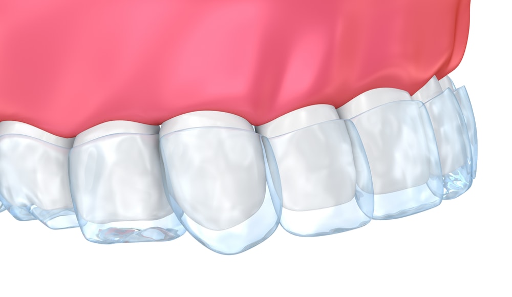 Teeth whitening trays fitting onto frontal upper teeth