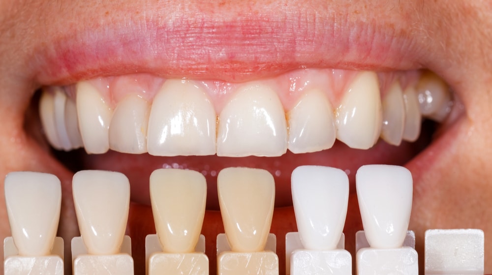 what is the natural tooth color