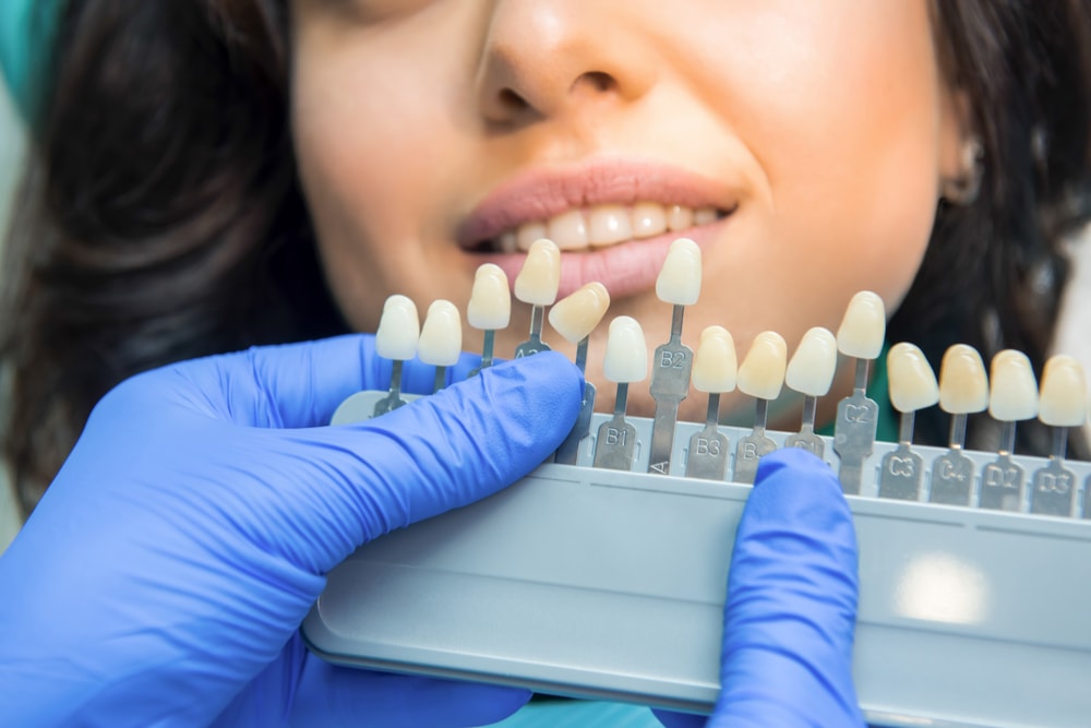Tooth Shade Guide Sutton Place Dental Associates