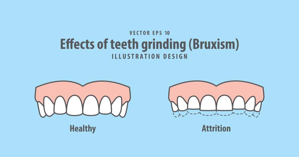 Image showing teeth wearing down as a result of teeth grinding