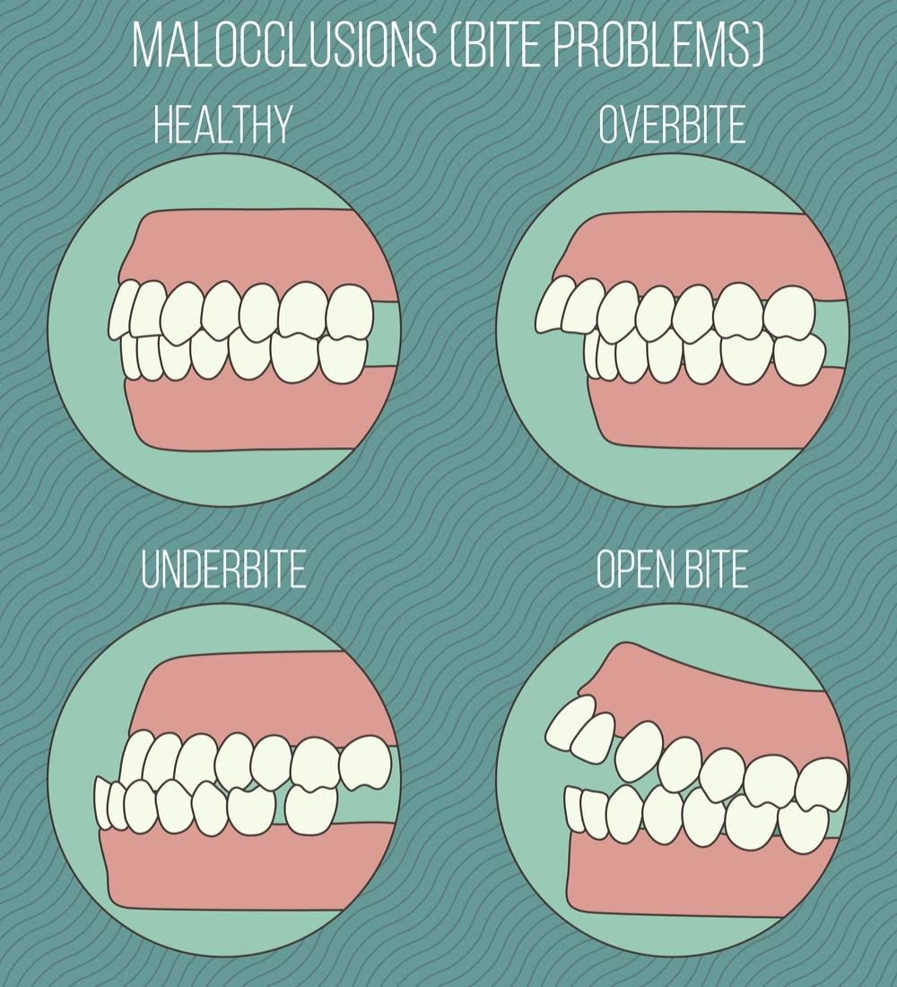 It Feels Wrong To Bite People Malocclusion problems, bad bite - Sutton Place Dental Associates