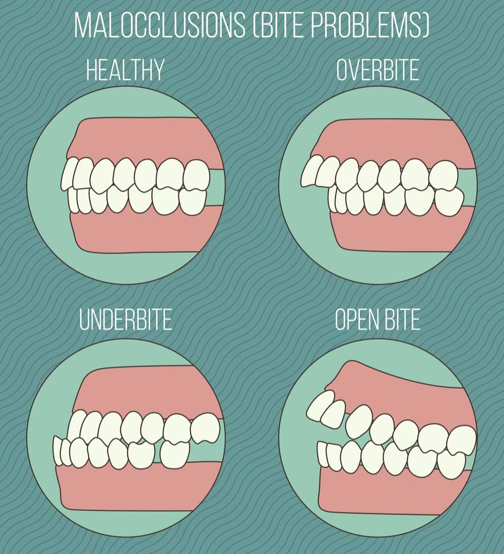 Images of a healthy bite, overbite, underbite and open bite.