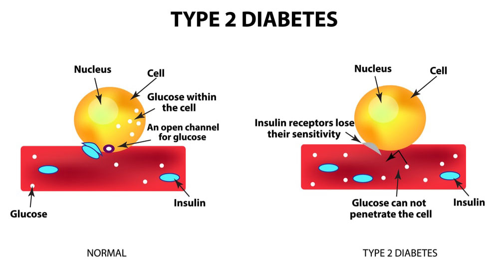 qualitative research on type 2 diabetes