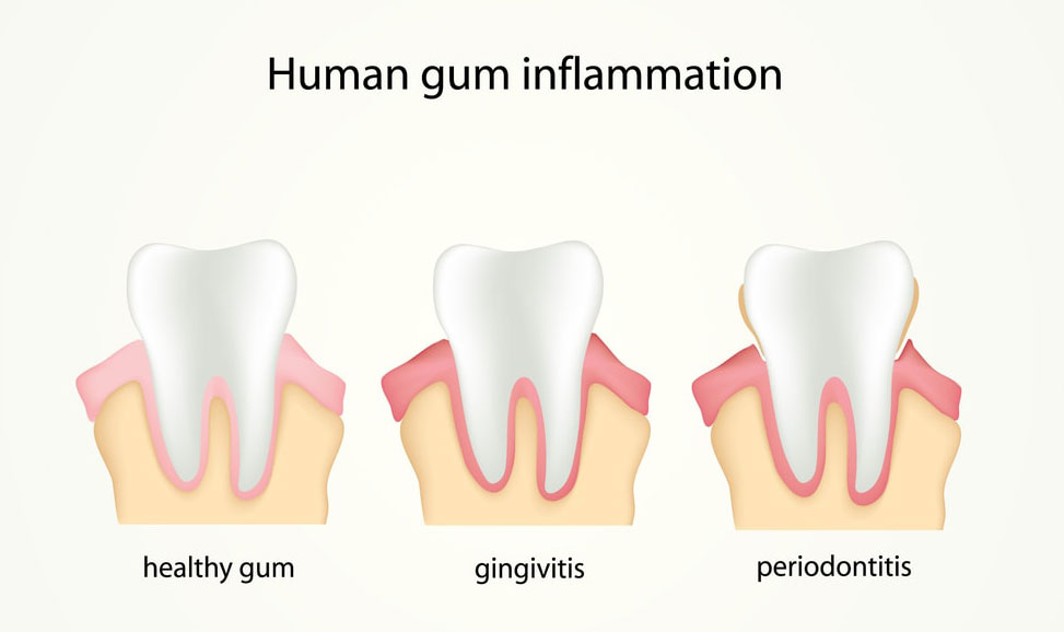 Different stages of human gum inflammation