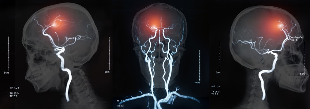 Cerebrovascular disease or hemorrhagic stroke