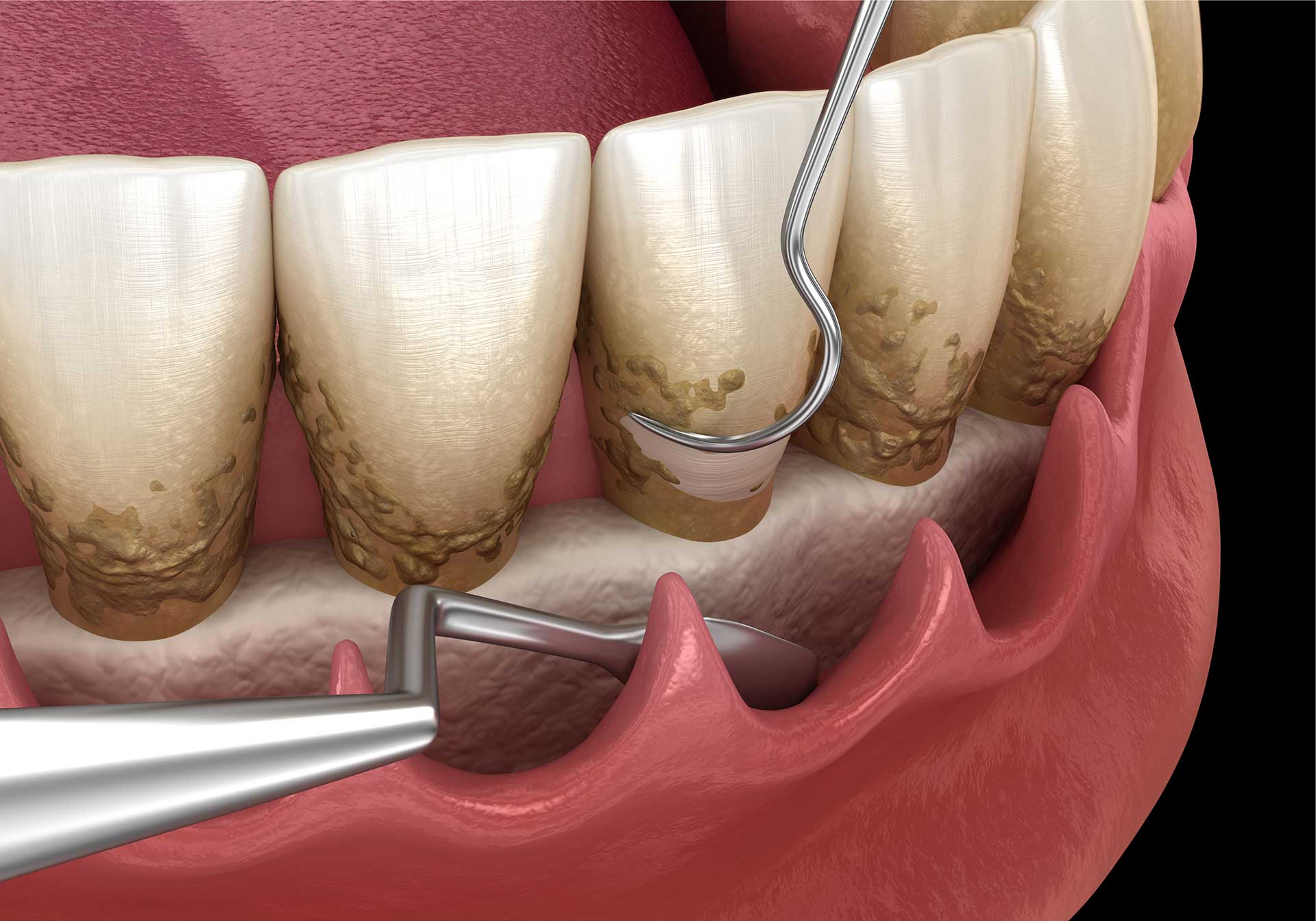 Scaling teeth