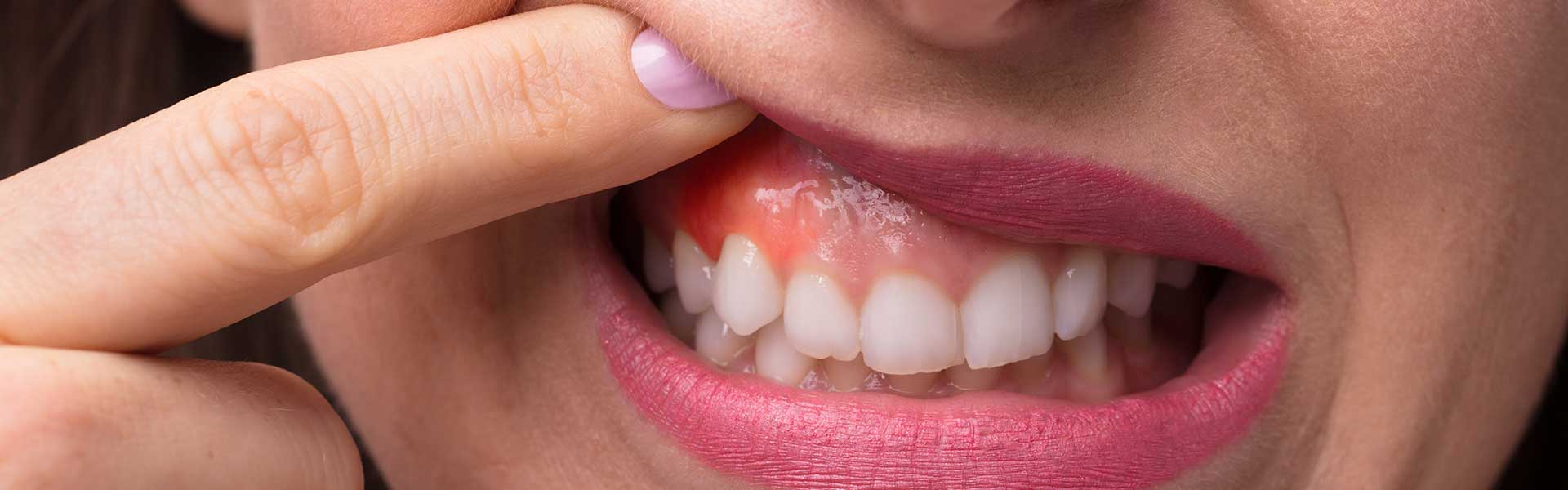 GUMS DISEASE