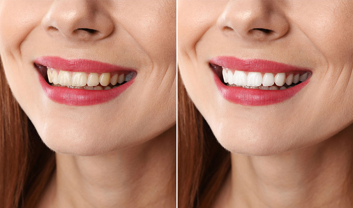 Zoom Whitening
