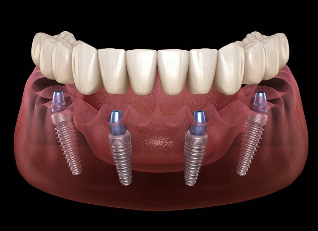 ALL-ON-4 DENTURES