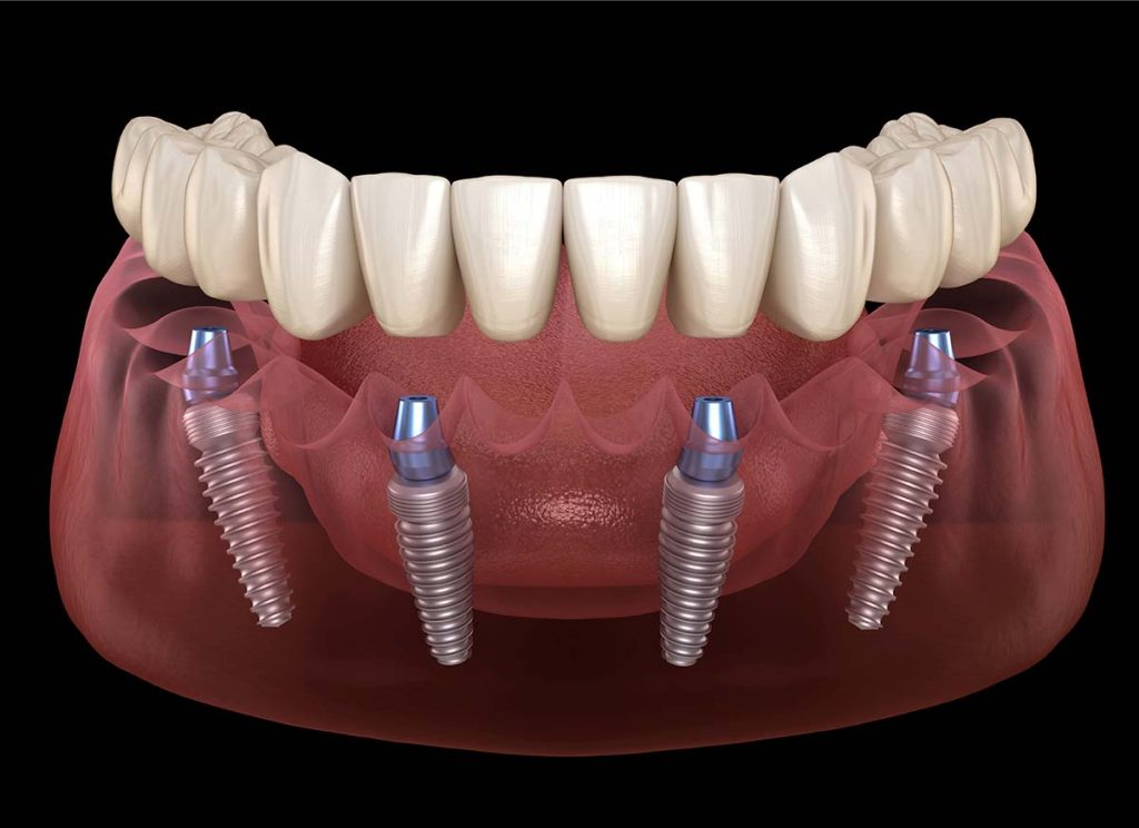 All-on-4 Dental Implants