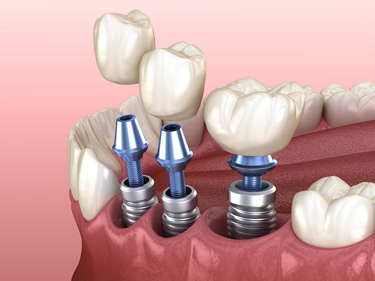 Dental Implants