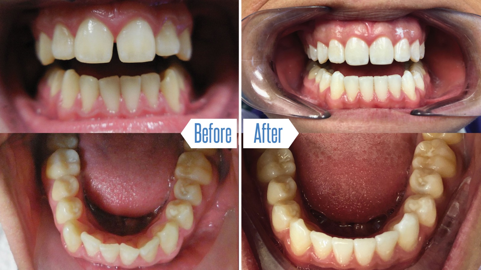 Invisalign - before and after