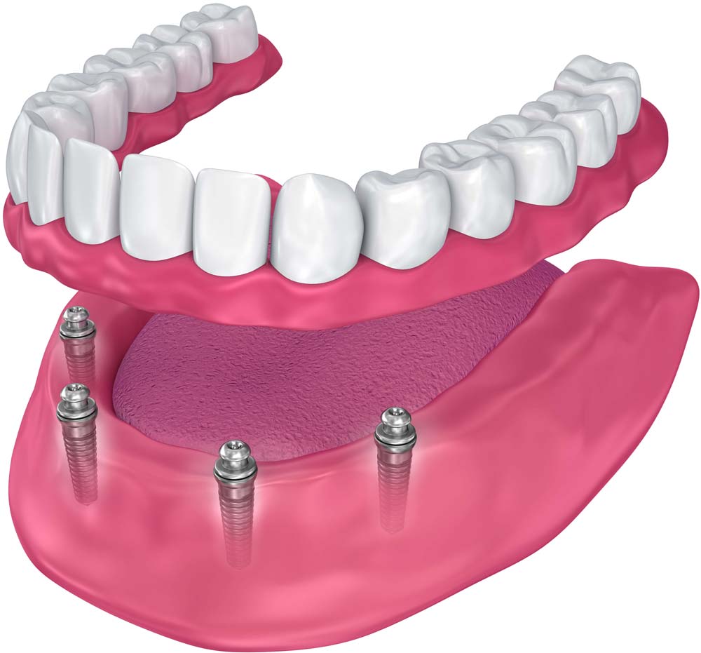 Snap-on dentures