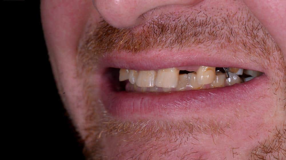 Cosmetic Dental Bonding Before