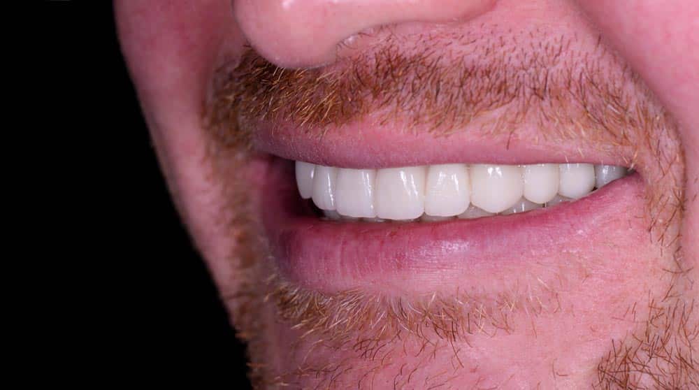 Cosmetic Dental Bonding After