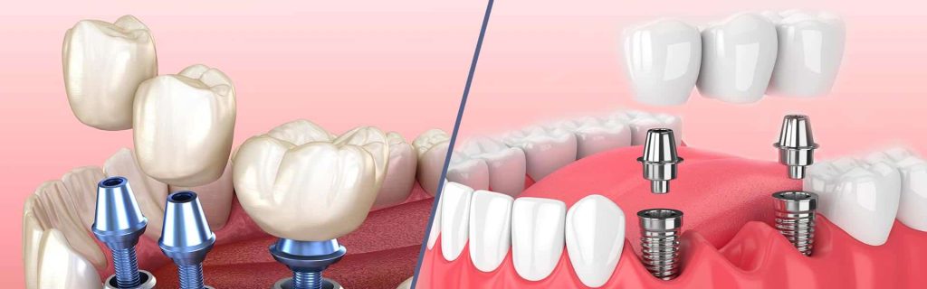 Photo of dental implants in Manhattan, NY with screws.