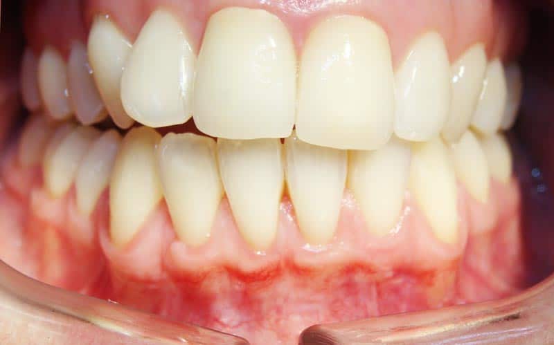 Full set of teeth showing gums after minimally invasive gum grafting.