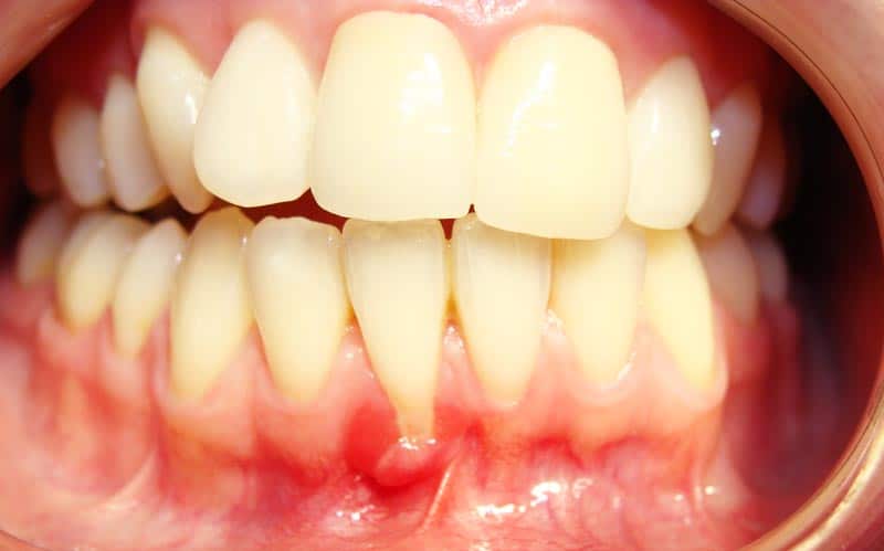 Minimally invasive gum grafting - Before