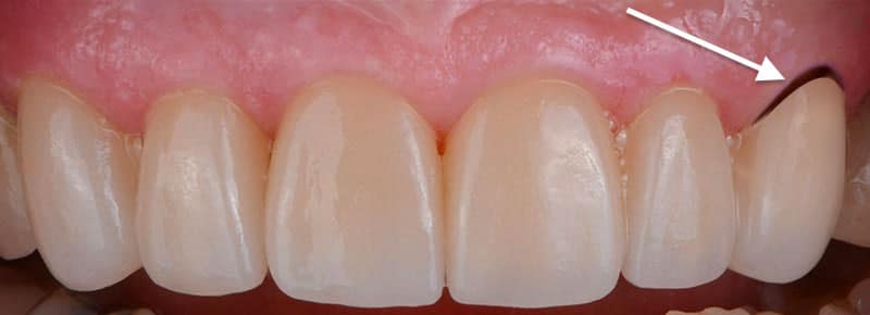 Black line around the base of your dental crown