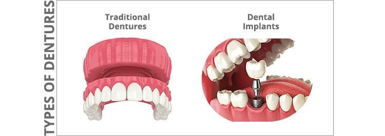 Types of Dentures