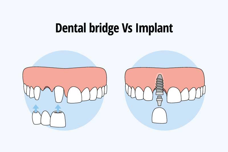 Dental Bridge vs. Implant