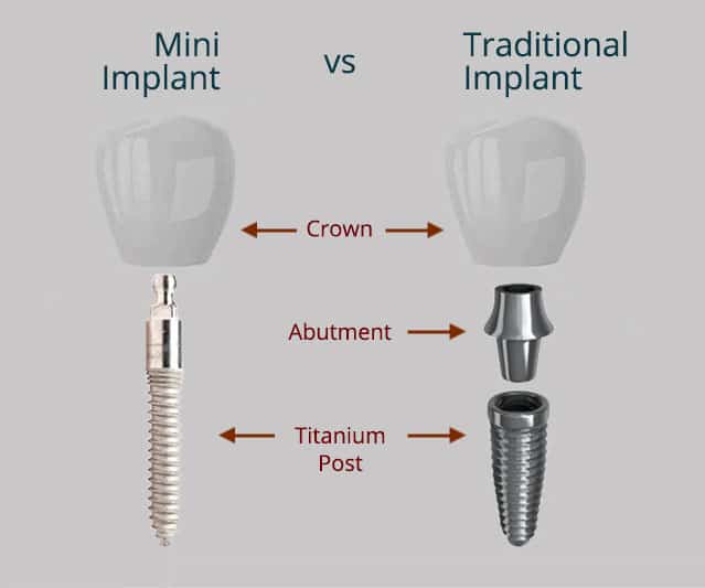 Mini vs. Traditional Implant