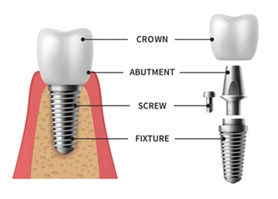 Temporary Dental Implant for Children with Missing Teeth