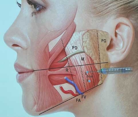 Method of Therapeutic Botox
